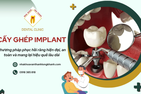 Cấy ghép Implant là gì? Tìm hiểu chi tiết trước khi thực hiện