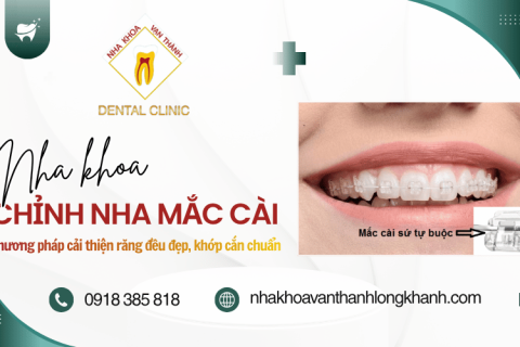 Chỉnh nha mắc cài: Phương pháp cải thiện răng đều đẹp, khớp cắn chuẩn