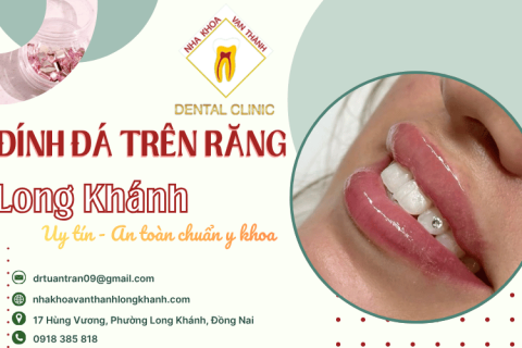 Dịch vụ đính đá trên răng tại Long Khánh uy tín, an toàn chuẩn y khoa 