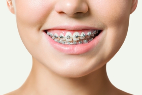 LỢI ÍCH CỦA VIỆC NIỀNG RĂNG